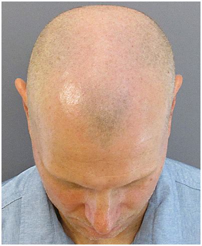 bosley smp|Scalp Micropigmentation vs. Microblading .